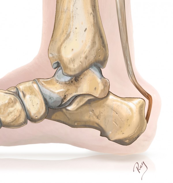 Tendinopathie — Wikipédia