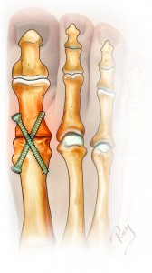 Arthrodèse de l’hallux par vis pour arthrose