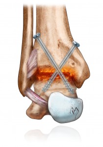 Arthrodesis (blocking) of the ankle using screws