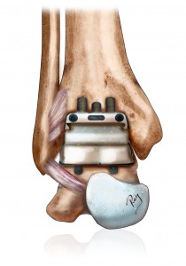 Prothèse de la cheville pour arthrose