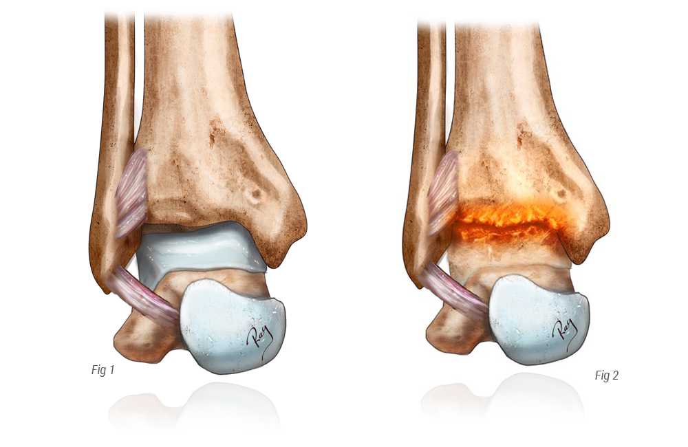 Arthrose de cheville : traitement et opération