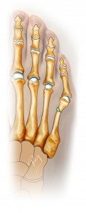 Ostéotomie de fermeture percutanée – excision d’un fragment osseux en coin