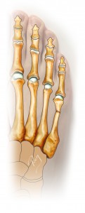 Fermeture de l’ostétomie, réalignant le métatarsien et l’orteil