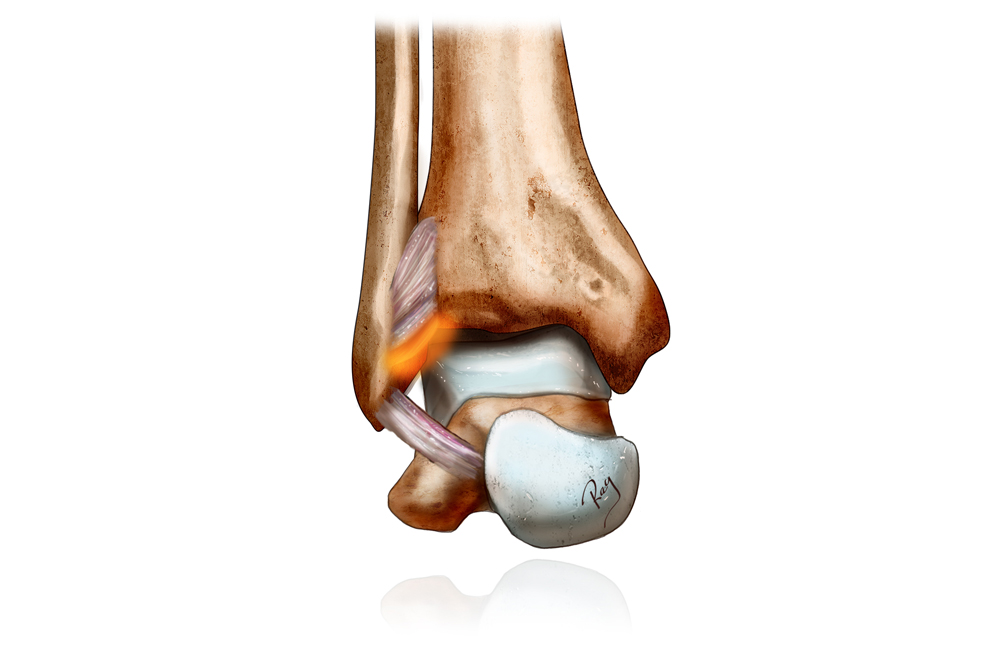 Conflit articulaire cheville - syndesmose lésée