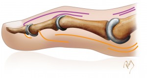 Correction percutanée de griffe avec section sequencielle des tendons