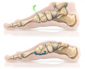 Arthrodèse selon Lapidus, hallux valgus