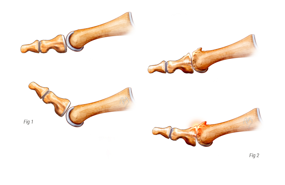 Hallux normal vs Hallux rigidus