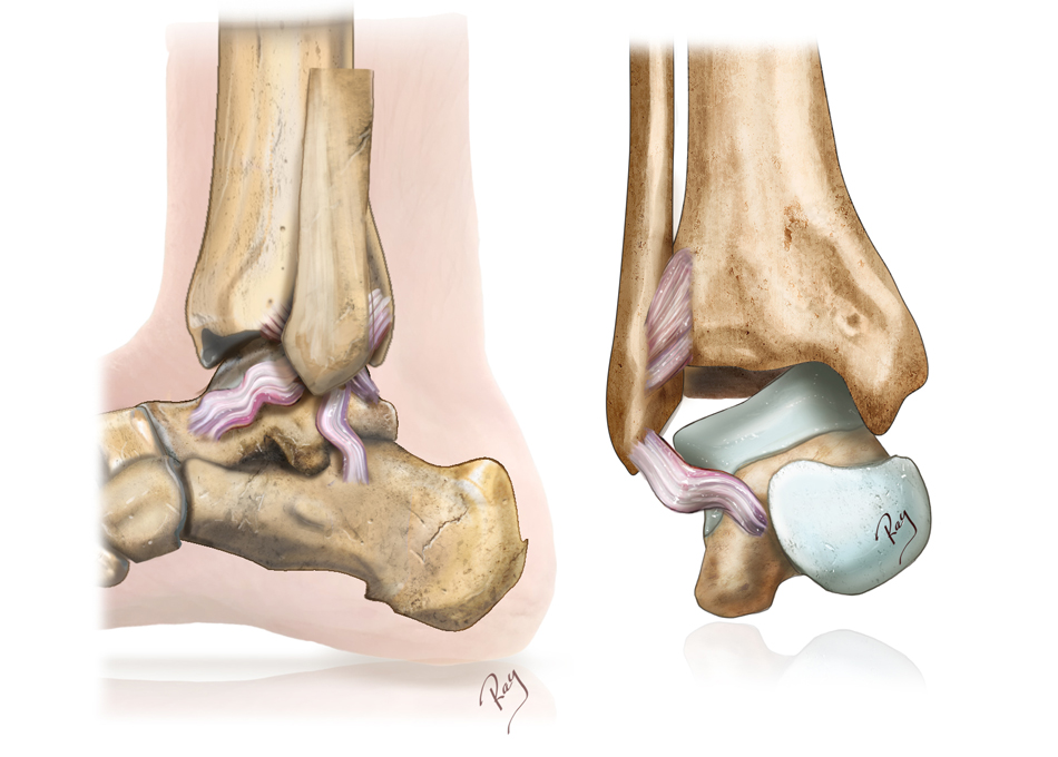 Cheville instable, ligaments détendus et incompétents