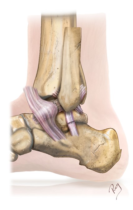 Intervention de Brostöm-Gould, rétension ligamentaire