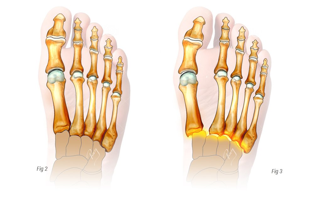 pied normal vs Luxation traumatique du Lisfranc