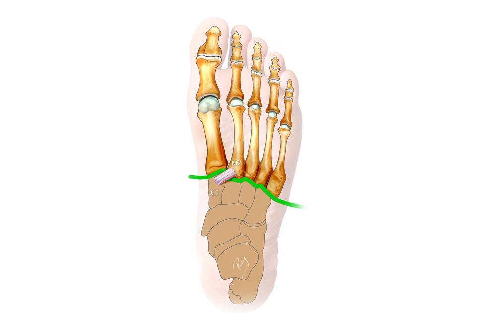 Lésions du Lisfranc