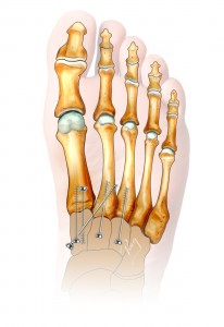 Acute arthrodesis or stabilisation of Lisfranc by screws