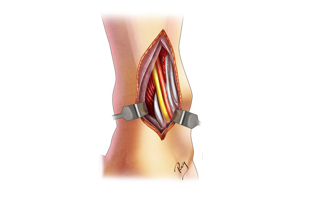 chirurgie ouverte - intervention structures neuro-vasculaires cheville