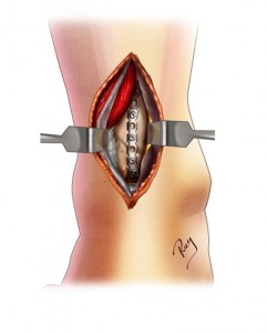 chirurgie ouverte - implantation d’une plaque