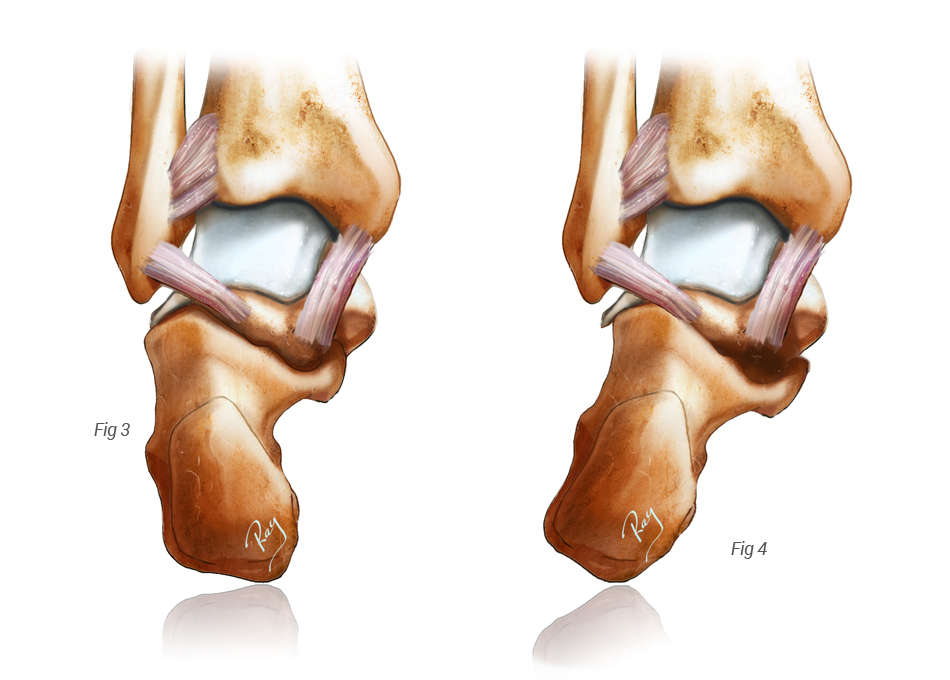 Pied normal vs pied plat