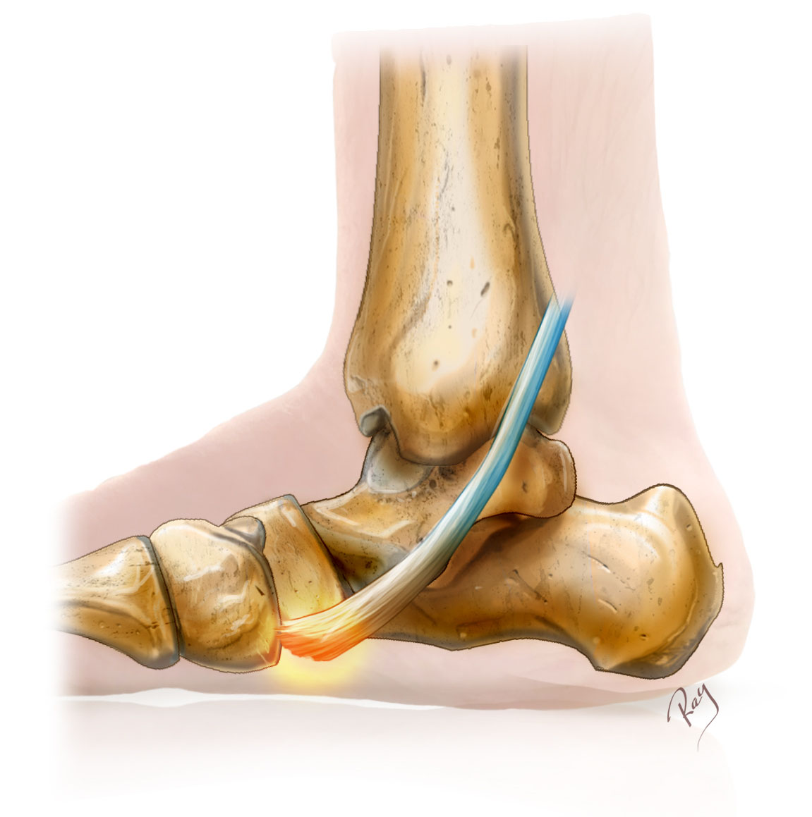 Pied plat - tendon tibial postérieur (Tendinopathie)