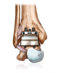 Prothèse implantée dans la cheville