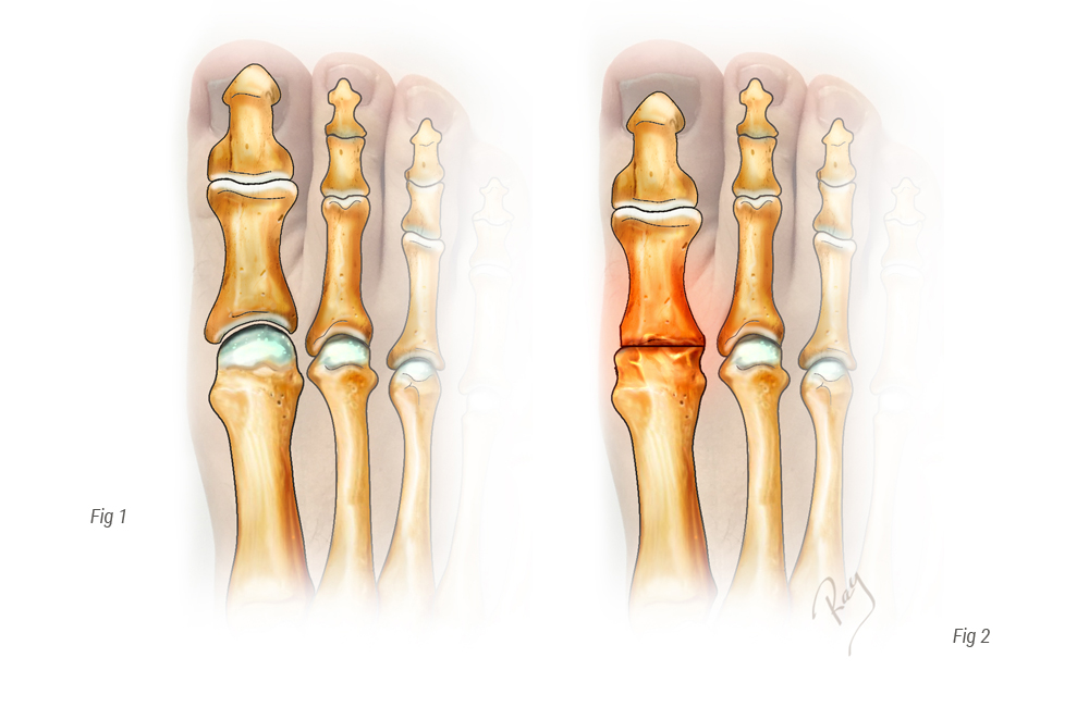 Hallux Rigidus