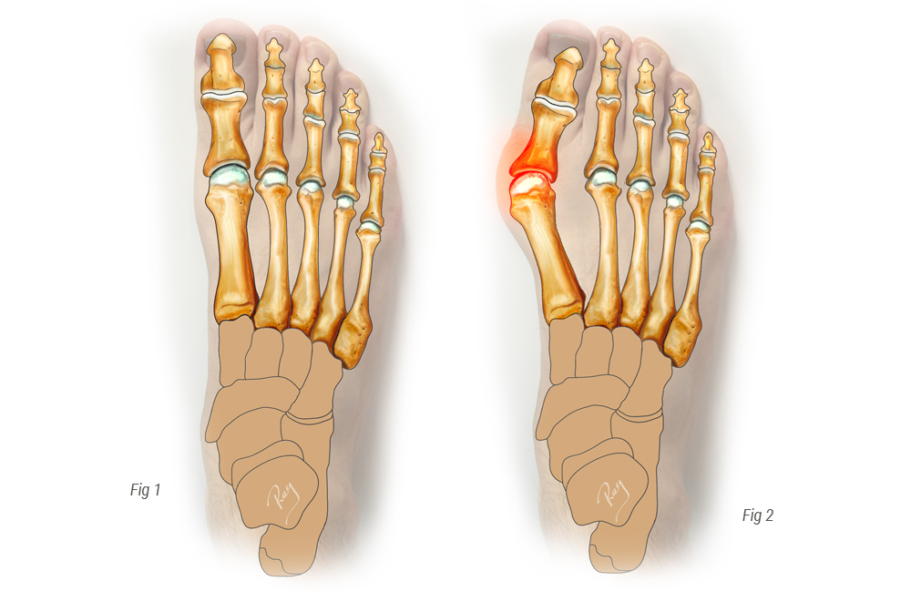 Hallux valgus : opération, traitement et origine | Centre du Pied