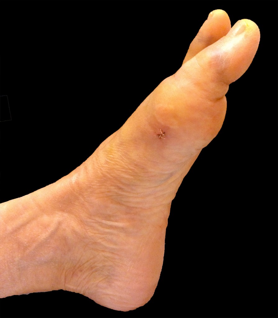 Taille de la cicatrice lors d’une correction d’un hallux valgus percutané