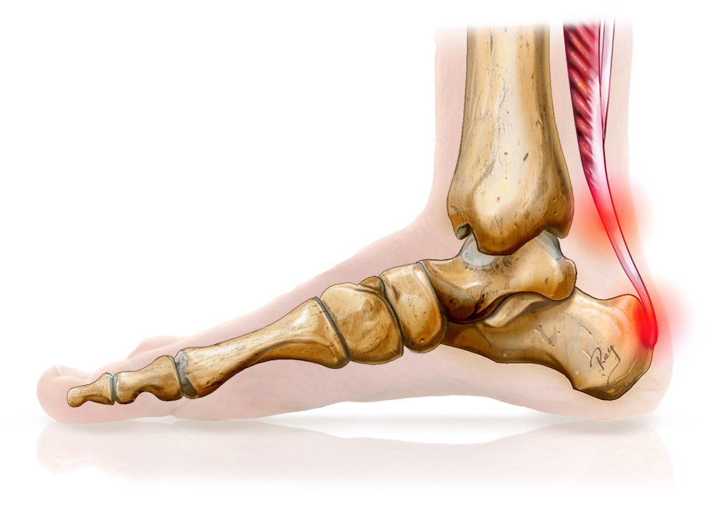 tendinopathies intentionnelles et non-insertionnelles