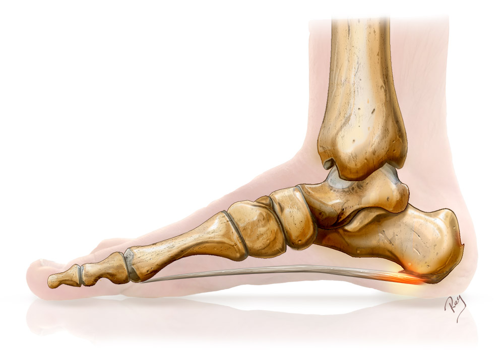 fasciite plantaire et épine calcanéenne